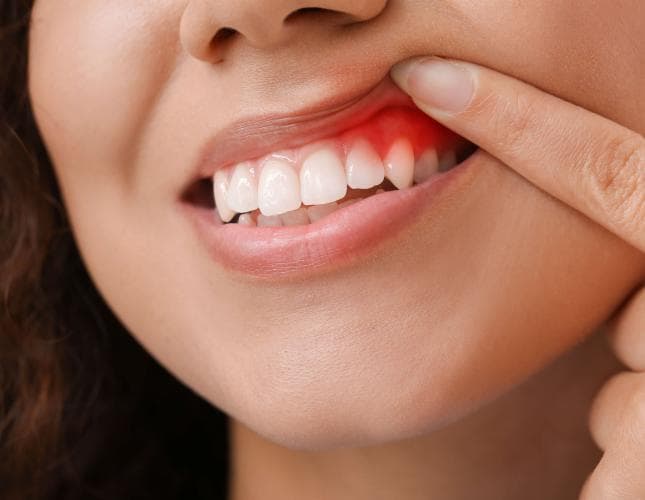 Gingivitis 101: Understanding the Basics of Gum Inflammation