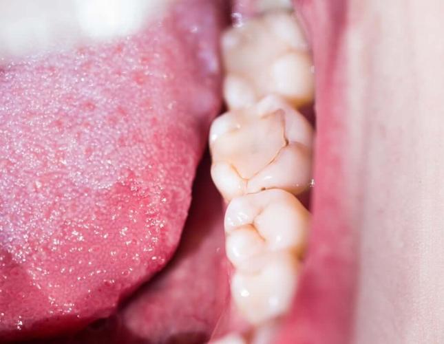 3 Signs that Your Dental Filling Is Going Bad