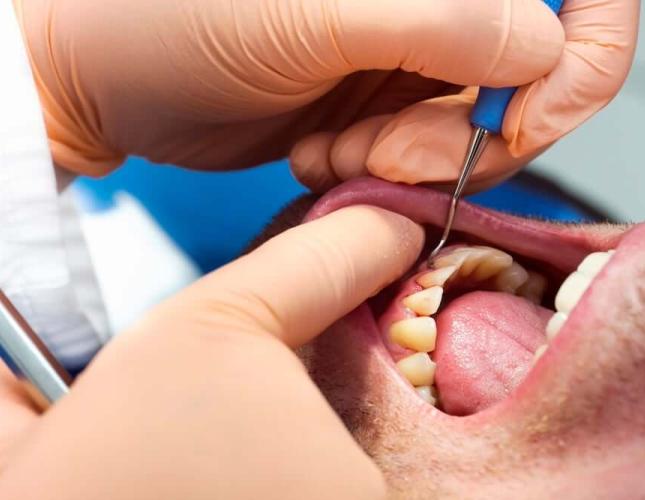 The Stages of Periodontitis: Understanding the Progression